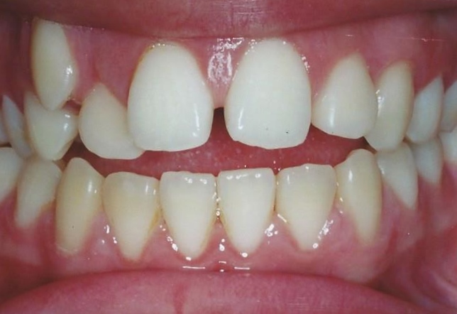 INTRAORAL, CASE5